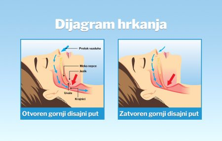 ovo je dijagram hrkanja, otvoren i zatvoren disajni put